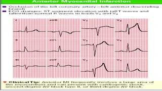 Acute Myocardial Infarction Infarction.pptx