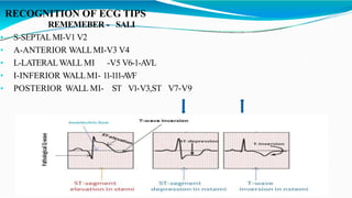 RECOGNITION OF ECG TIPS
REMEMEBER - SALI
• S-SEPTALMI-V1 V2
• A-ANTERIOR WALLMI-V3 V4
• L-LATERALWALL MI -V5 V6-1-AVL
• I-INFERIOR WALLMI- 11-111-A
VF
• POSTERIOR WALL MI- ST V1-V3,ST V7-V9
 