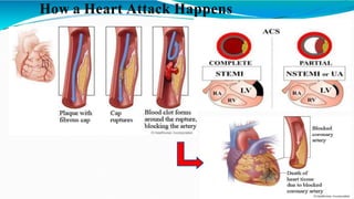 How a Heart Attack Happens
 