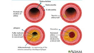 Tunica Intima
Tunica media
T.Adventitia
plaques
Thrombus
Atherosclerosis –is a narrowing of the
arteries caused by a buildup of plaque
 