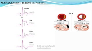 MANAGEMENT (STEMI vs. NSTEMI)
 