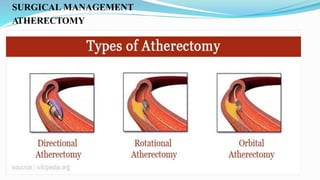 SURGICAL MANAGEMENT
ATHERECTOMY
 
