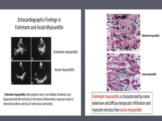Acute myocarditis - Dr.vikash kumar, BSMU | PPT