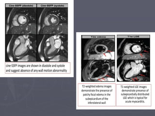 Acute myocarditis - Dr.vikash kumar, BSMU | PPT