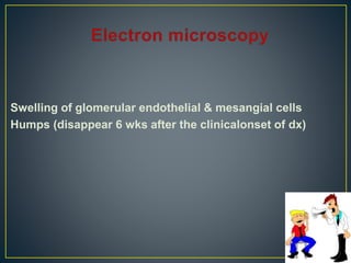 Swelling of glomerular endothelial & mesangial cells
Humps (disappear 6 wks after the clinicalonset of dx)
 