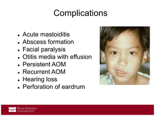  Acute mastoiditis
 Abscess formation
 Facial paralysis
 Otitis media with effusion
 Persistent AOM
 Recurrent AOM
 Hearing loss
 Perforation of eardrum
Complications
 