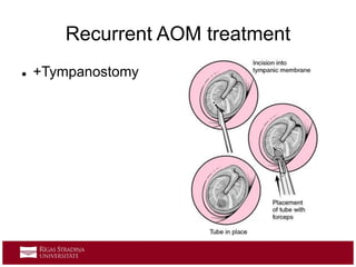 Recurrent AOM treatment
 +Tympanostomy
 