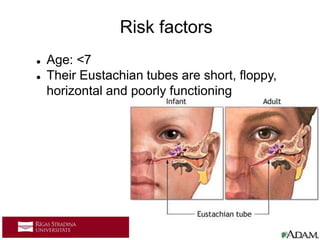  Age: <7
 Their Eustachian tubes are short, floppy,
horizontal and poorly functioning
Risk factors
 