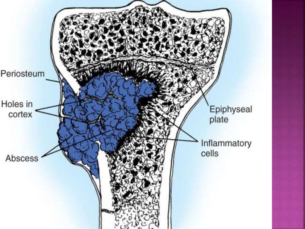 Acute osteomyelitis
