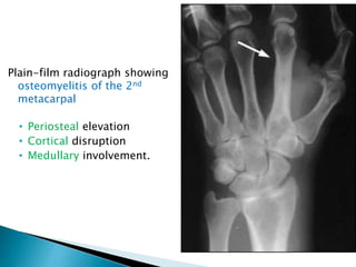 Plain-film radiograph showing
osteomyelitis of the 2nd
metacarpal
• Periosteal elevation
• Cortical disruption
• Medullary involvement.
 