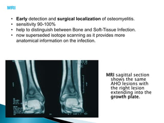 MRI
• Early detection and surgical localization of osteomyelitis.
• sensitivity 90-100%
• help to distinguish between Bone and Soft-Tissue Infection.
• now superseded isotope scanning as it provides more
anatomical information on the infection.
MRI sagittal section
shows the same
AHO lesions with
the right lesion
extending into the
growth plate.
 