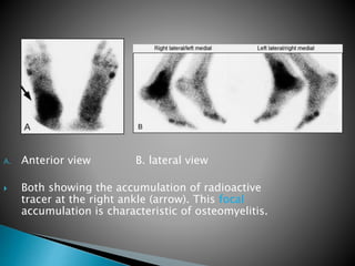 A. Anterior view B. lateral view
 Both showing the accumulation of radioactive
tracer at the right ankle (arrow). This focal
accumulation is characteristic of osteomyelitis.
 