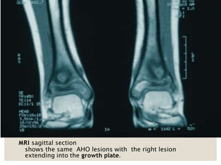 MRI sagittal section
shows the same AHO lesions with the right lesion
extending into the growth plate.
 