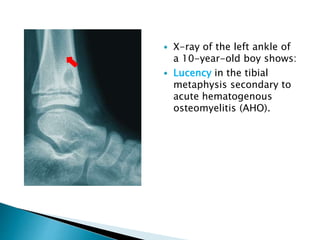  X-ray of the left ankle of
a 10-year-old boy shows:
 Lucency in the tibial
metaphysis secondary to
acute hematogenous
osteomyelitis (AHO).
 