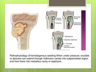 Pathophysiology of hematogenous seeding.When under pressure, exudate
or abscess can extend through Volkmann canals into subperiosteal region
and from there into medullary cavity or epiphysis.
 