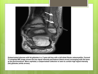 Subperiosteal abscess with fat globules in a 7-year-old boy with a left distal fibular osteomyelitis. Coronal
T1-weighted MR image shows the low signal intensity periosteum (black arrow) converging with the bone
at the perichondrium. More cephalad, a subperiosteal collection is seen to contain high signal intensity
(fat) globules (white arrows).
 