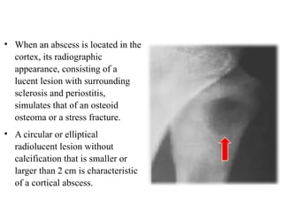 Comprehensive Overview of Acute Osteomyelitis: Pathogenesis ...