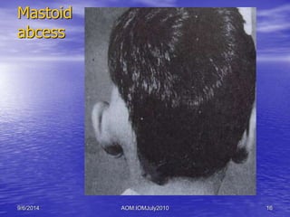 Mastoid 
abcess 
9/6/2014 AOM:IOMJuly2010 16 
 