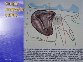 Simple 
mastoide 
ctomy 
9/6/2014 AOM:IOMJuly2010 17 
 