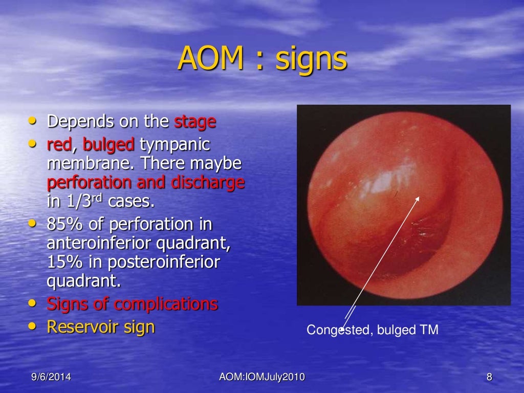 Acute otitis media
