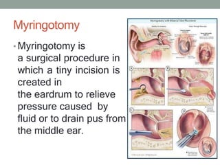 Myringotomy
• Myringotomy is
a surgical procedure in
which a tiny incision is
created in
the eardrum to relieve
pressure c...