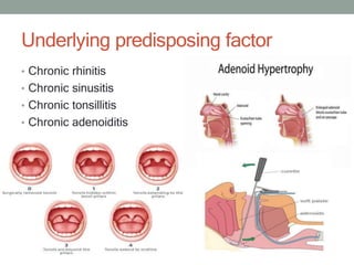Underlying predisposing factor
• Chronic rhinitis
• Chronic sinusitis
• Chronic tonsillitis
• Chronic adenoiditis
 