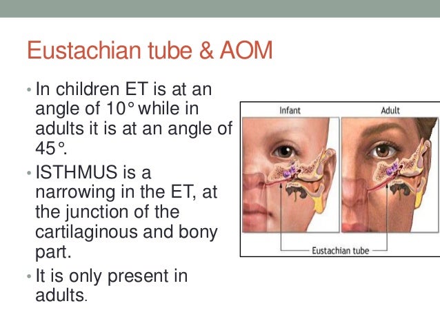 Acute otitis media