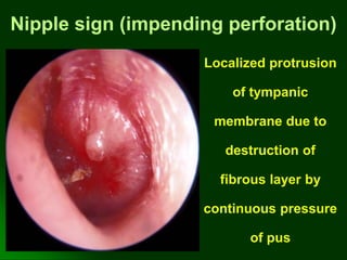 Nipple sign (impending perforation)
Localized protrusion
of tympanic
membrane due to
destruction of
fibrous layer by
continuous pressure
of pus
 