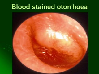 Blood stained otorrhoea
 