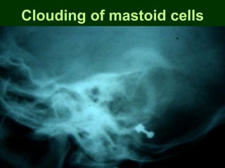 Clouding of mastoid cells
 