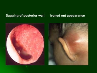 Sagging of posterior wall Ironed out appearance
 