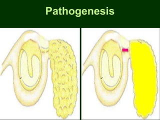 Pathogenesis
 