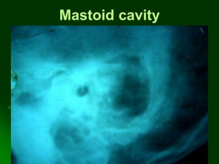 Mastoid cavity
 