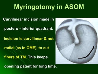 Myringotomy in ASOM
Curvilinear incision made in
postero - inferior quadrant.
Incision is curvilinear & not
radial (as in OME), to cut
fibers of TM. This keeps
opening patent for long time.
 