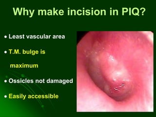 Why make incision in PIQ?
 Least vascular area
 T.M. bulge is
maximum
 Ossicles not damaged
 Easily accessible
 