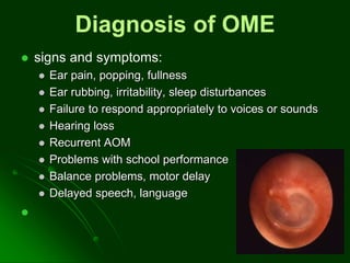 Diagnosis of OME
 signs and symptoms:
 Ear pain, popping, fullness
 Ear rubbing, irritability, sleep disturbances
 Failure to respond appropriately to voices or sounds
 Hearing loss
 Recurrent AOM
 Problems with school performance
 Balance problems, motor delay
 Delayed speech, language

 