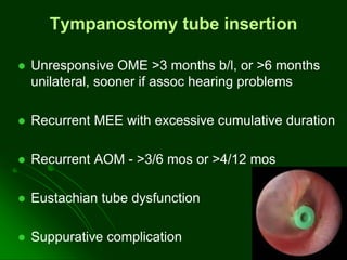 Tympanostomy tube insertion
 Unresponsive OME >3 months b/l, or >6 months
unilateral, sooner if assoc hearing problems
 Recurrent MEE with excessive cumulative duration
 Recurrent AOM - >3/6 mos or >4/12 mos
 Eustachian tube dysfunction
 Suppurative complication
 