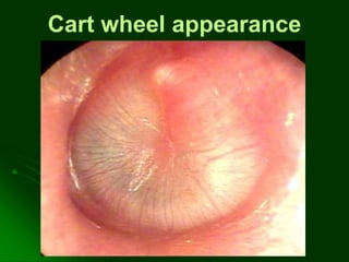 Cart wheel appearance
 