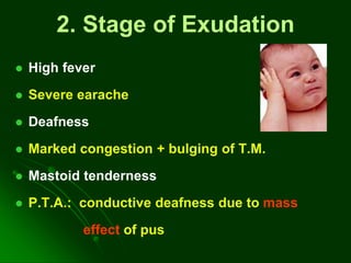 2. Stage of Exudation
 High fever
 Severe earache
 Deafness
 Marked congestion + bulging of T.M.
 Mastoid tenderness
 P.T.A.: conductive deafness due to mass
effect of pus
 