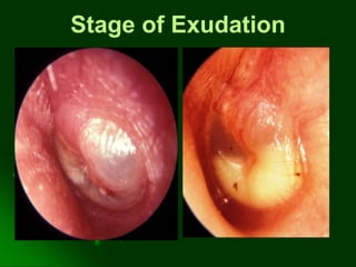 Stage of Exudation
 