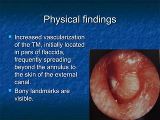 Physical findingsPhysical findings
 Increased vascularizationIncreased vascularization
of the TM, initially locatedof the TM, initially located
in pars of flaccida,in pars of flaccida,
frequently spreadingfrequently spreading
beyond the annulus tobeyond the annulus to
the skin of the externalthe skin of the external
canal.canal.
 Bony landmarks areBony landmarks are
visible.visible.
 
