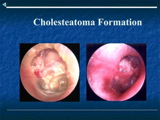 Cholesteatoma Formation
 