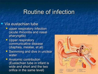 Routine of infectionRoutine of infection
 Via eustachian tubeVia eustachian tube
 upper respiratory infectionupper respiratory infection
(acute rhinonitis and nasal(acute rhinonitis and nasal
pharyngitis)pharyngitis)
 Upper respiratoryUpper respiratory
communicative diseasecommunicative disease
(diaphea, mealse, et al)(diaphea, mealse, et al)
 Swimming and dive in unclearSwimming and dive in unclear
waterwater
 Anatomic contributionAnatomic contribution
(Eustachian tube in infant is(Eustachian tube in infant is
wide and short and the twowide and short and the two
orifice in the same level)orifice in the same level)
 