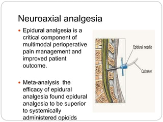 Neuroaxial analgesia
 Epidural analgesia is a
critical component of
multimodal perioperative
pain management and
improved patient
outcome.
 Meta-analysis the
efficacy of epidural
analgesia found epidural
analgesia to be superior
to systemically
administered opioids
 
