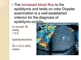  The increased blood flow to the
epididymis and testis on color Doppler
examination is a well-established
criterion for the diagnosis of
epididymo-orchitis.
In normal- RI
rarely
< 0.5
Epididymorchitis
-
RI < 0.5 in 50%
cases.
 