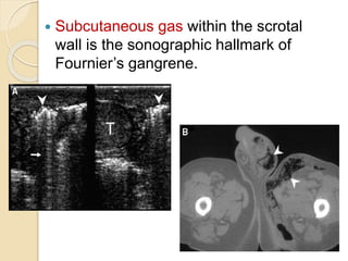  Subcutaneous gas within the scrotal
wall is the sonographic hallmark of
Fournier’s gangrene.
 