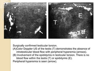 Surgically confirmed testicular torsion.
(A)Color Doppler US of the testis (T) demonstrates the absence of
intratesticular blood flow with peripheral hyperemia (arrows).
(B) Involvement of the epididymis in testicular torsion. There is no
blood flow within the testis (T) or epididymis (E).
Peripheral hyperemia is seen (arrow).
 