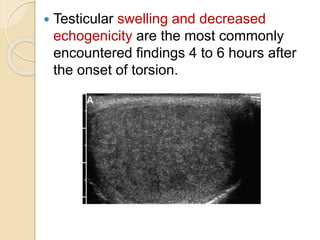  Testicular swelling and decreased
echogenicity are the most commonly
encountered findings 4 to 6 hours after
the onset of torsion.
 