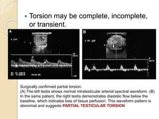  Torsion may be complete, incomplete,
or transient.
Surgically confirmed partial torsion.
(A) The left testis shows normal intratesticular arterial spectral waveform. (B)
In the same patient, the right testis demonstrates diastolic flow below the
baseline, which indicates loss of tissue perfusion. This waveform pattern is
abnormal and suggests PARTIAL TESTICULAR TORSION
 