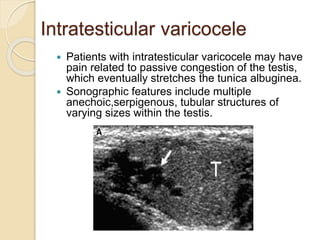 Intratesticular varicocele
 Patients with intratesticular varicocele may have
pain related to passive congestion of the testis,
which eventually stretches the tunica albuginea.
 Sonographic features include multiple
anechoic,serpigenous, tubular structures of
varying sizes within the testis.
 